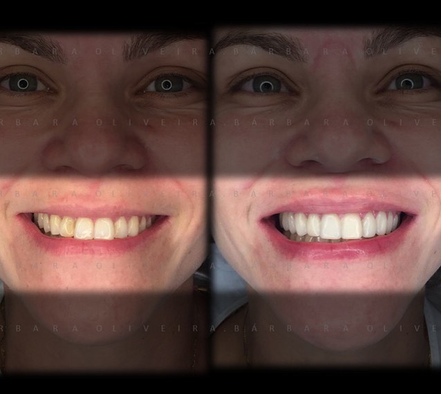 ⚜️10 Lentes em Resina⚜️ .... deixando paciente que já era linda, mais linda ainda.____♀️_._Resultado em sessão única⏱__Com desgaste mínimo___Sem dor___Sem anestesia___Melhora de formato e cor_____._De acordo com a .jpg
