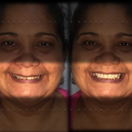 Lentes em resina composta _DUAS horas entre uma foto e outra._._._._._#lentesemresinacomposta  #esteliteomega #muriae #muriae #muriaemg #muriaé #descomplica #miraimg #miradouromg #itaperunarj #porciuncularj #patroc.jpg