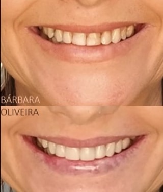 Como eu goxto!!♥️__✨Dessa opção tão acessível e descomplicada que são as resinas compostas.__✨Pequenas e grandes mudanças são possíveis!__✨Que triste seria se só tivéssemos uma única opção de tratamento, de orçamen.jpg