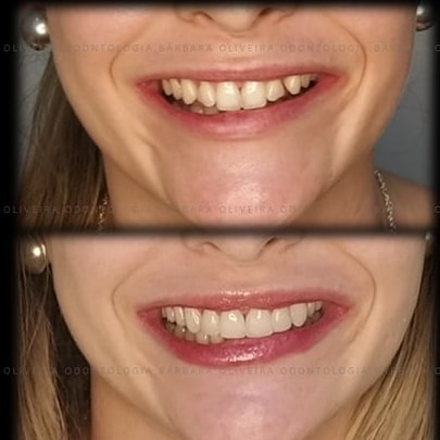 E esse sorriso... __⌛Em uma tarde fizemos essa mudança que foi linda de ver (e fazer)...___Paciente linda, nova... Com resinas antigas, pigmentadas, fraturadas, dentes conoides (pequenos), diastemas (espaços).__Jun.jpg