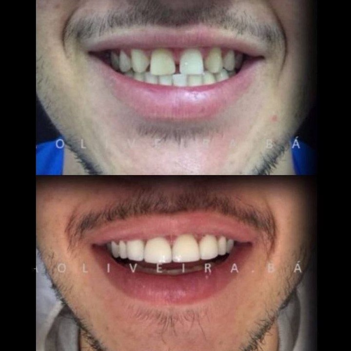 Sempre é possível melhorar.__E poque não agora__Um sorriso muda tudo.___.__.__.__.__.__.__.__#preenchimentolabial #muriae #muriae #botox #acidohialuronico #contornolabial #harmonizaçãofacial #mg #dentista #sorriso .jpg